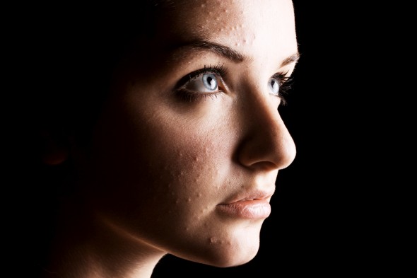 The Most Overlooked Fact About Acne Women Need to Know