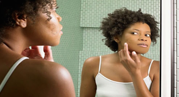 How to Get Rid of Acne with these 7 Super Foods