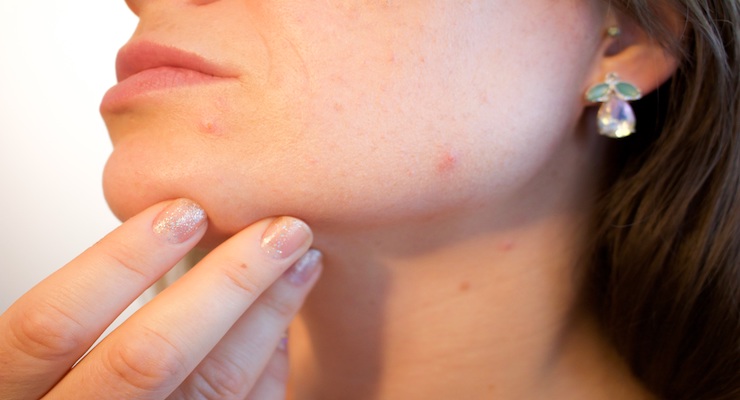 4 Most Common Skin Problems that can be Naturally Treated